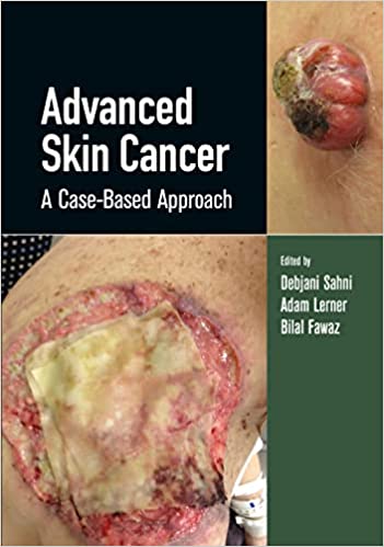 Advanced Skin Cancer A Case Based Approach