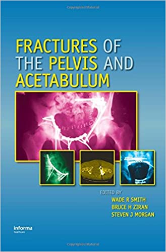 Fractures of the Pelvis and Acetabulum