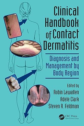 Clinical Handbook of Contact Dermatitis Diagnosis and Management by Body Region