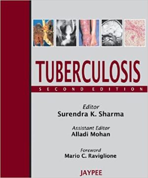 Tuberculosis 2nd Edition