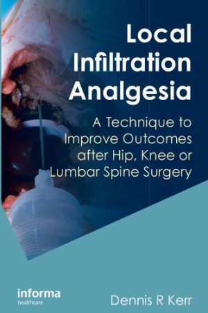 Local Infiltration Analgesia A Technique to Improve Outcomes After Hip Knee or Lumbar Spine Surgery
